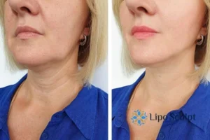 Double chin before and after Hi-Fu treatment 4 Book your double chin treatment Northampton today! We are here to help!
