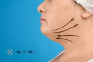 Double chin before and after Hi-Fu treatment 3 Boost your confidence with a Double chin treatment Northampton