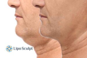 Double chin before and after Hi-Fu treatment 2 Double chin treatment Northampton from Lipo Sculpt - feel more confident today!