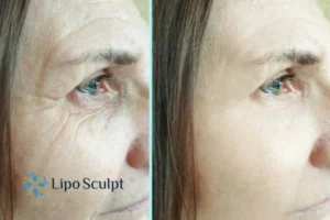 How to Fight Aging Symptoms 2 Do you want to Fight Aging Symptoms Northampton? Contact Lipo Sculpt today!