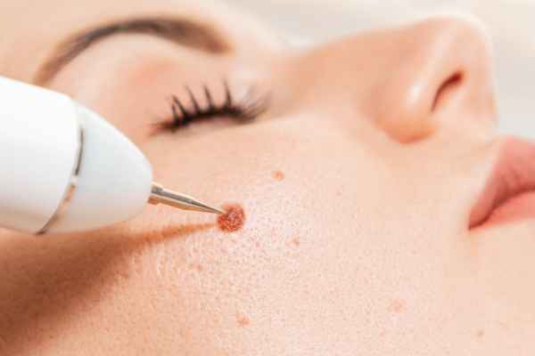 CryoPen: 5 Skin Concerns It May Be Used to Treat 3 What actually happens during a CryoPen treatment Northampton?
