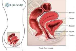 Treatment For A Leaky Bladder 2 How EM Chair treatment Northampton can help Leaky bladder issues. Read more now!